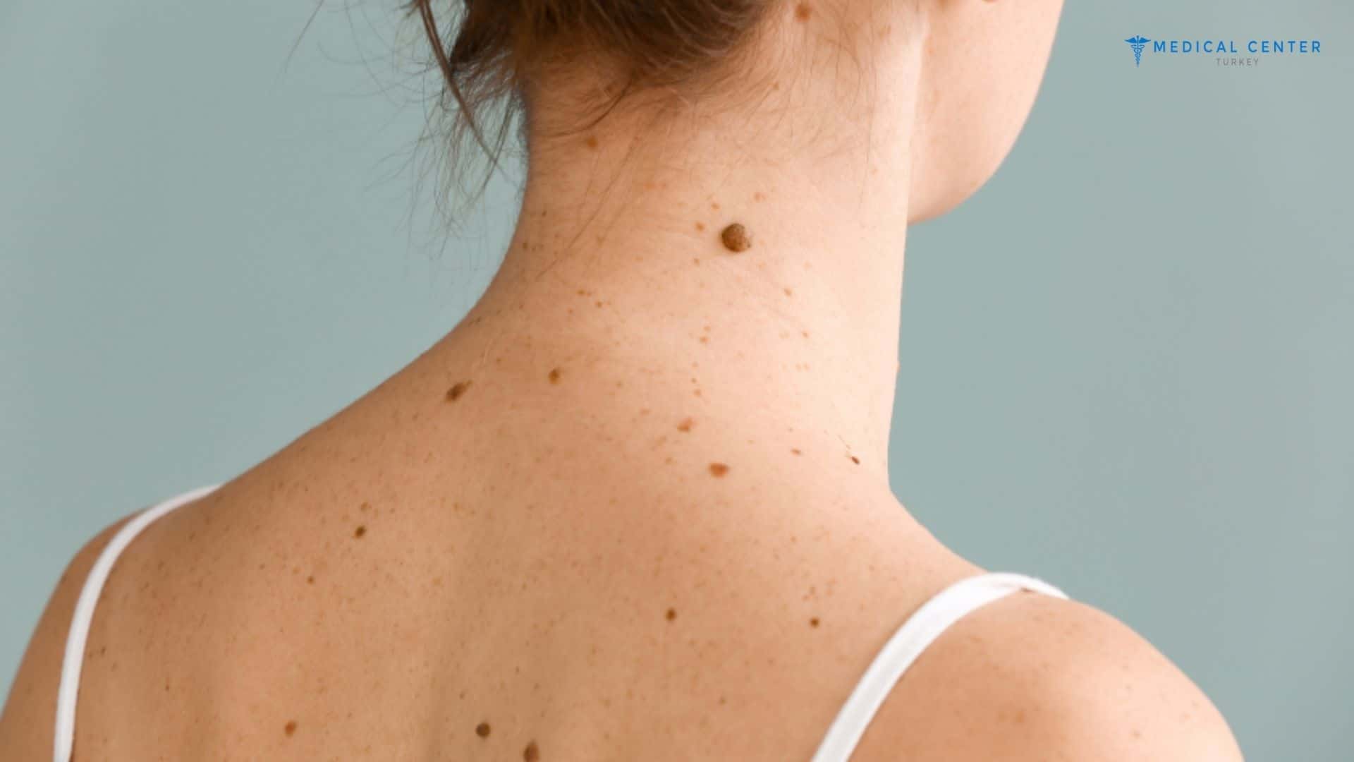 Reasons and Aesthetic Causes for Mole Removal