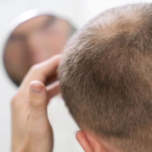 Hair Transplant Recovery Process and Care Tips Hair Transplant Recovery Process and Care Tips