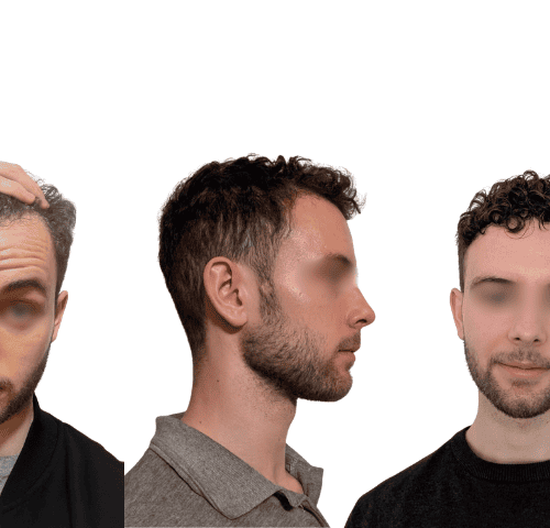 Mike’s Hair Transplant Journey