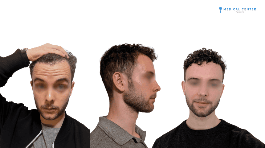 Mike’s Hair Transplant Journey