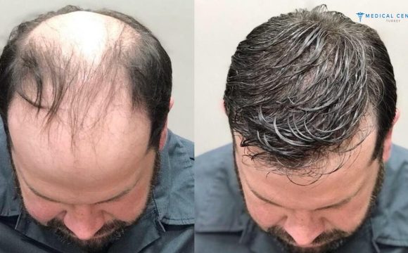 Henry Hair Transplant Experience