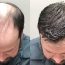 Henry Hair Transplant Experience