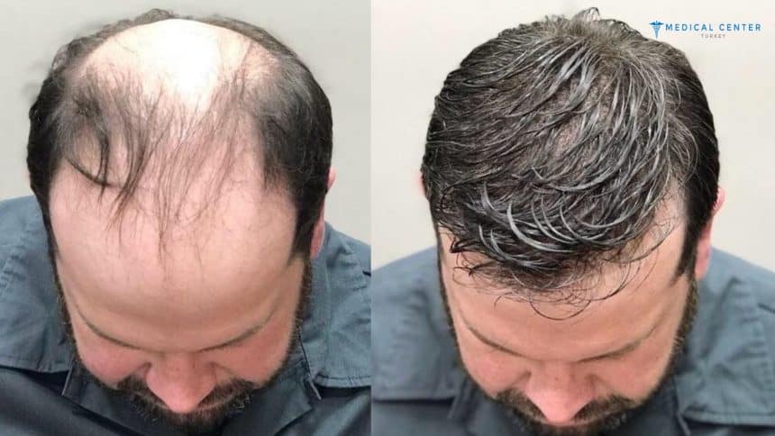 Henry Hair Transplant Experience