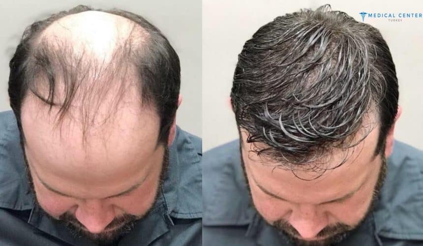 Henry Hair Transplant Experience Henry Hair Transplant Experience