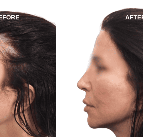 Emma Hair Transplant Experiences in Turkey