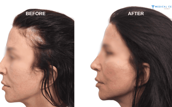 Emma Hair Transplant Experiences in Turkey