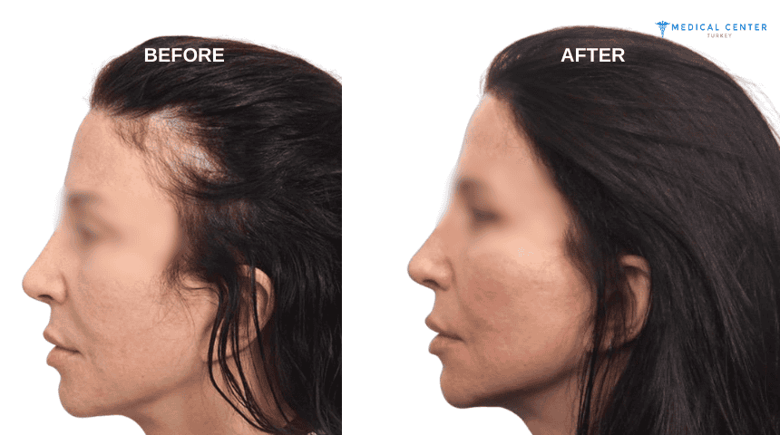 Emma Hair Transplant Experiences in Turkey