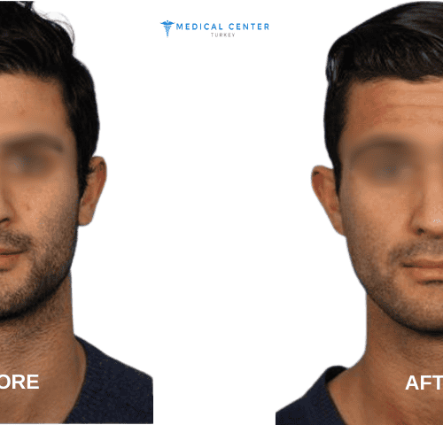 Harris’s Rhinoplasty Experiences in Turkey Harris’s Rhinoplasty Experiences in Turkey