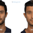 Harris’s Rhinoplasty Experiences in Turkey