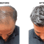 David’s Hair Transplant Experiences in Turkey