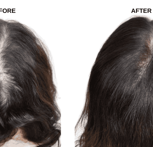 Zoya’s Hair Transplant Experiences in Turkey