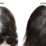 Zoya’s Hair Transplant Experiences in Turkey