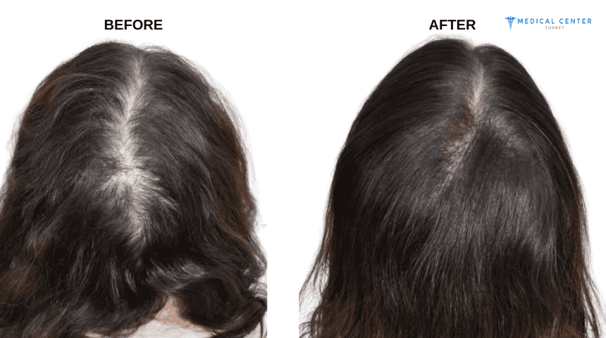 Zoya’s Hair Transplant Experiences in Turkey Zoya’s Hair Transplant Experiences in Turkey