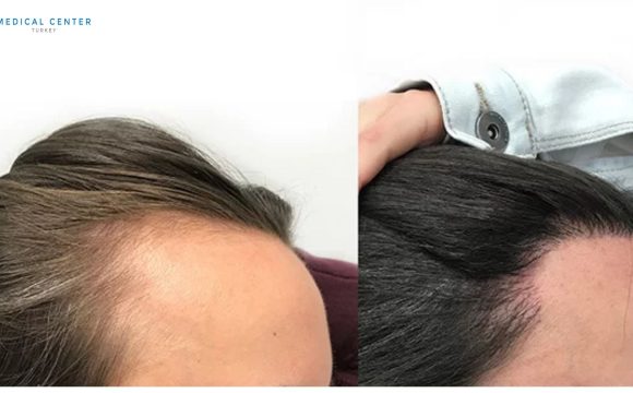 Zoe Hair Transplant Experince in Turkey