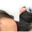 Zoe Hair Transplant Experince in Turkey