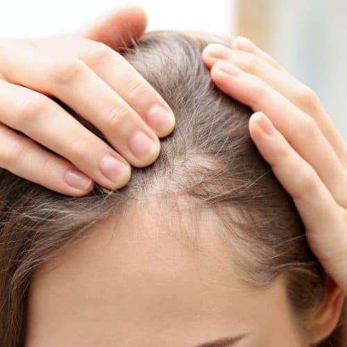 Emily’s Hair Transplant Journey Emily’s Hair Transplant Journey