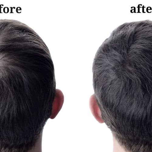 Leo's hair transplant experience in Turkey Leo's hair transplant experience in Turkey