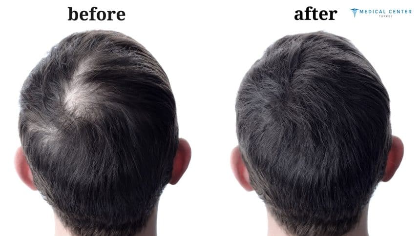 Leo's hair transplant experience in Turkey Leo's hair transplant experience in Turkey