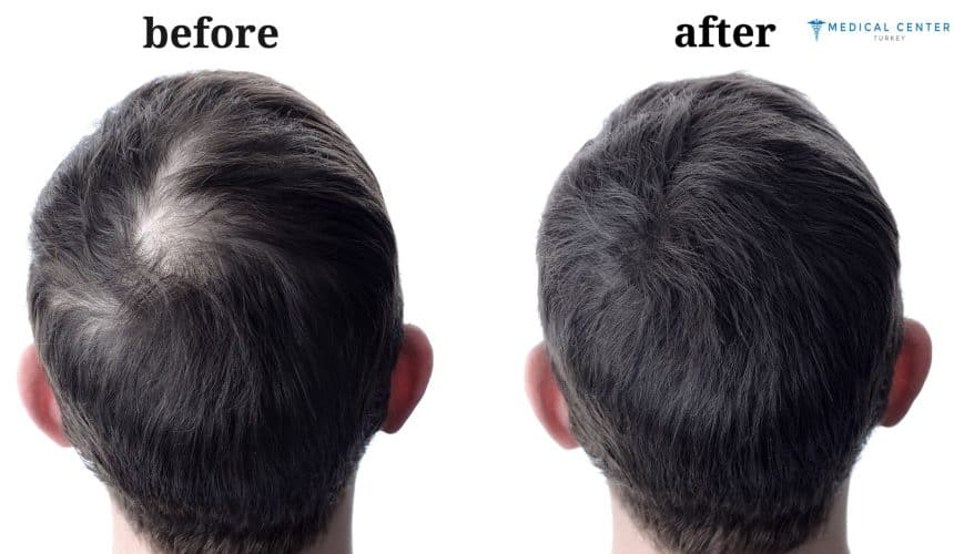 Leo's hair transplant experience in Turkey Leo's hair transplant experience in Turkey