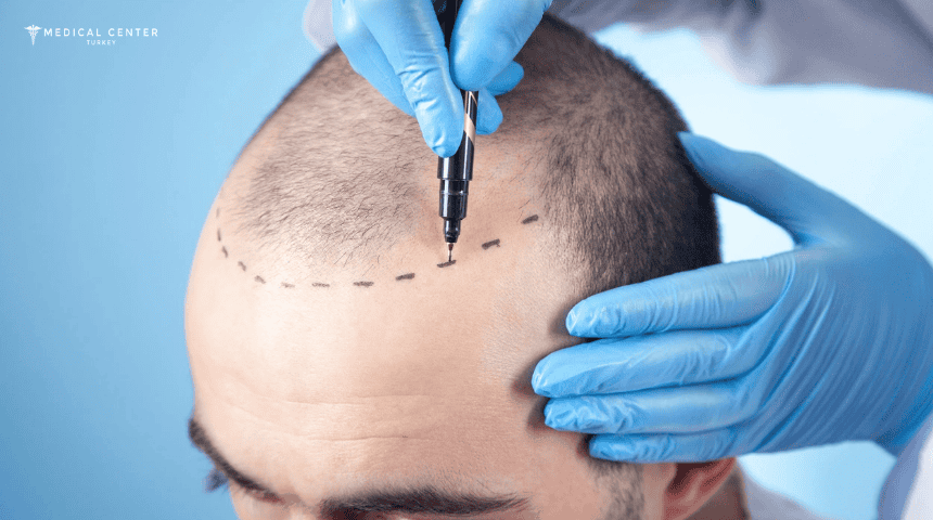 Hair Transplant Packages Turkey Hair Transplant Packages Turkey