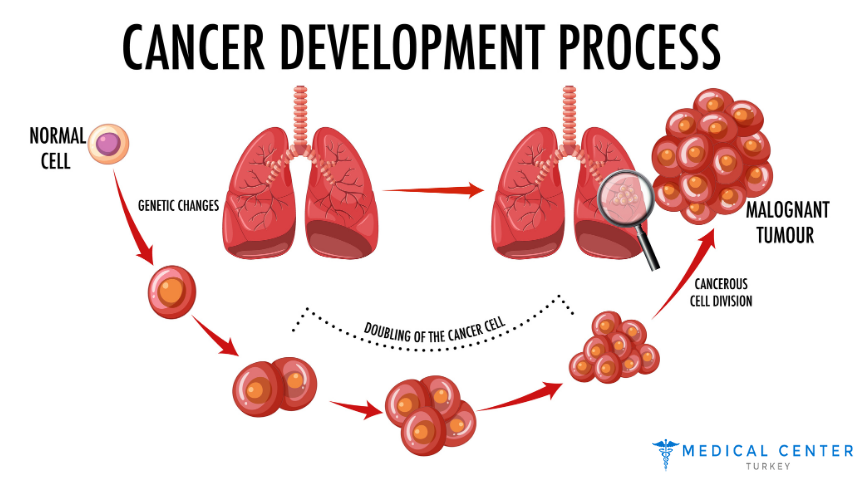 Lung Cancer Surgery in Turkey