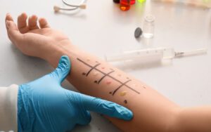 Close-up of a patient's arm undergoing a latex allergy test. Various allergens are applied in numbered spots.