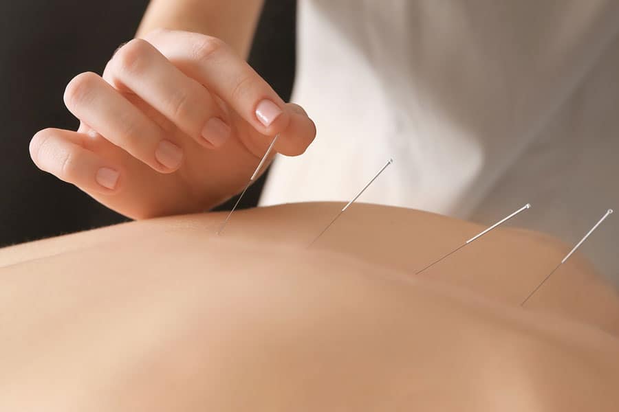 Needle acupuncture therapy for pain relief at New Plymouth Physiotherapy clinic in NZ.