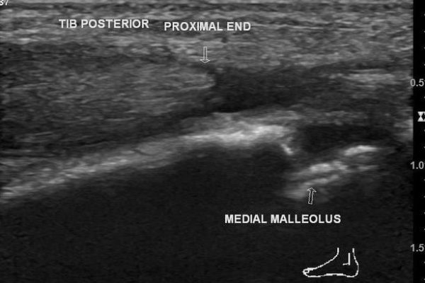 Tibialis posterior tendon ultrasound scan showing medial malleolus and tibial posterior tendons.