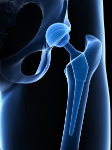 3d rendered illustration of a hip replacement