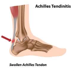 Tendonitis-OOC