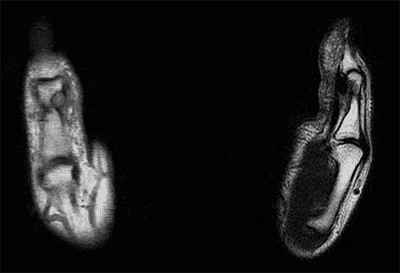 Donna-MRI-Scans-Hand-Tumor