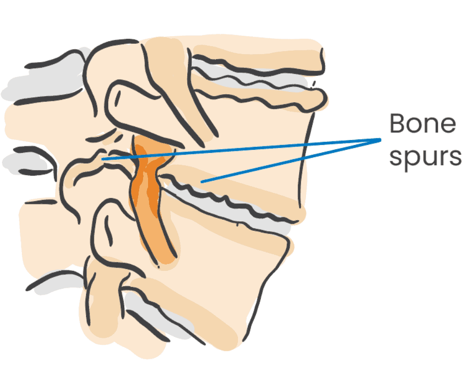 Bone Spurs