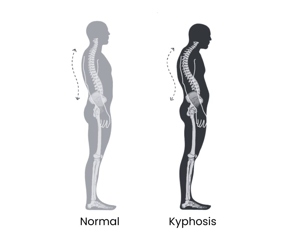 OOC Spine kyphosis interior photo