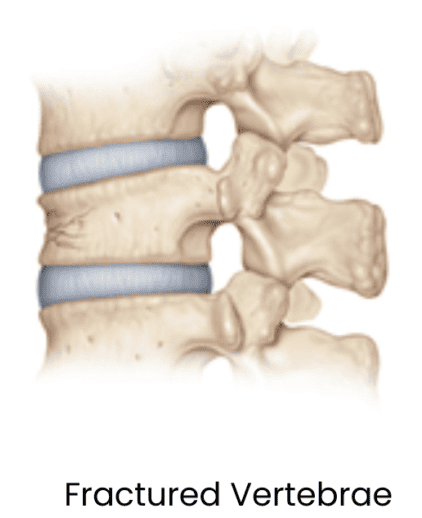 Vertebral Compression Fracture Vertebral Compression Fracture