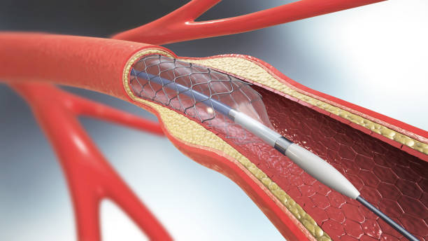 china Coronary Stent Market Sector in Transition: Assessing Risk, Resilience, and Policy Disruption