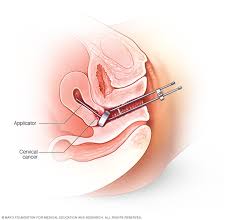 Brachytherapy Market Market Report Forecasts Dynamic Growth Through 2035