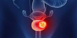 The Global Bladder Cancer Market is projected to reach USD 440.74 million by 2030.