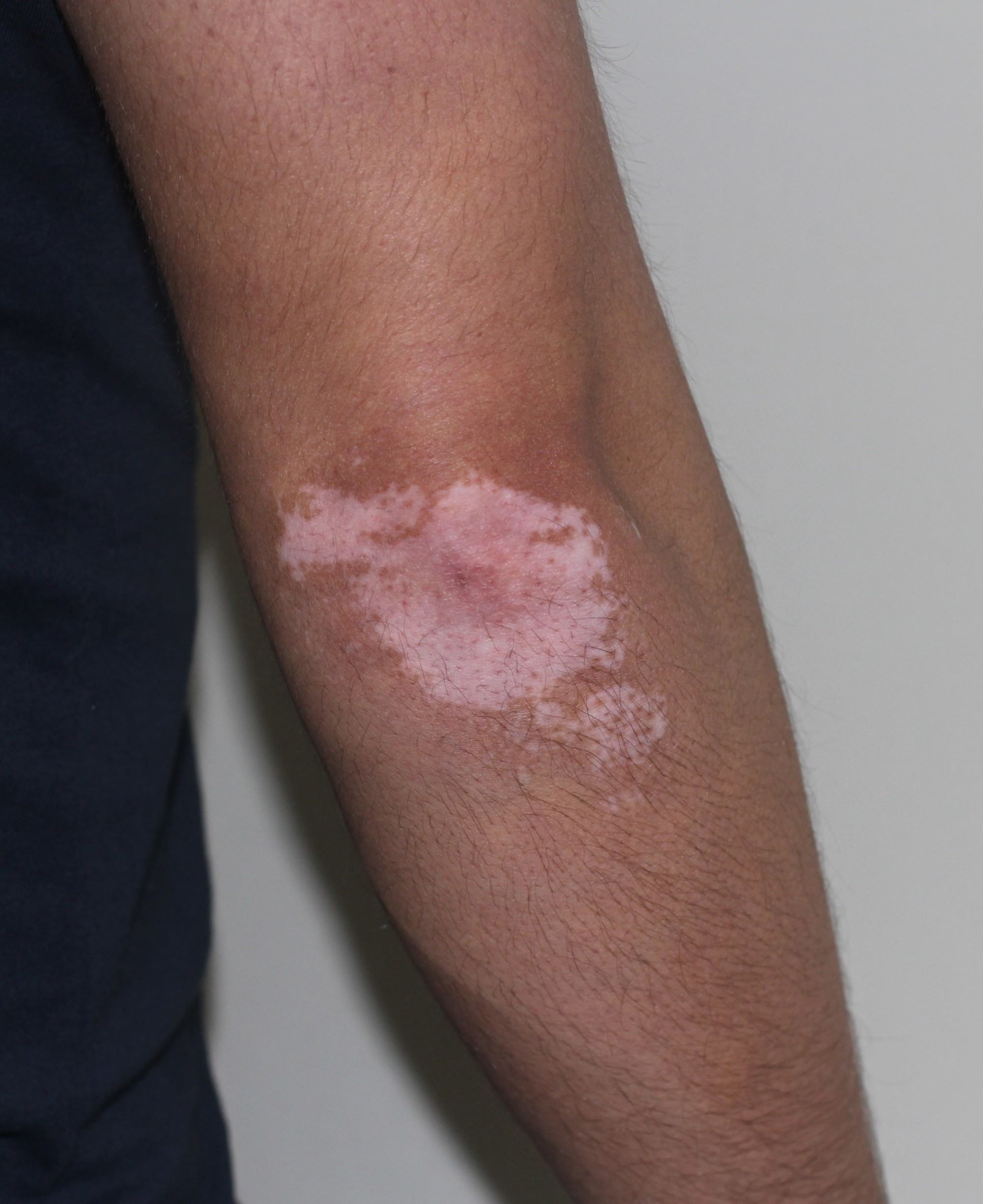 Vitiligo Before Camo