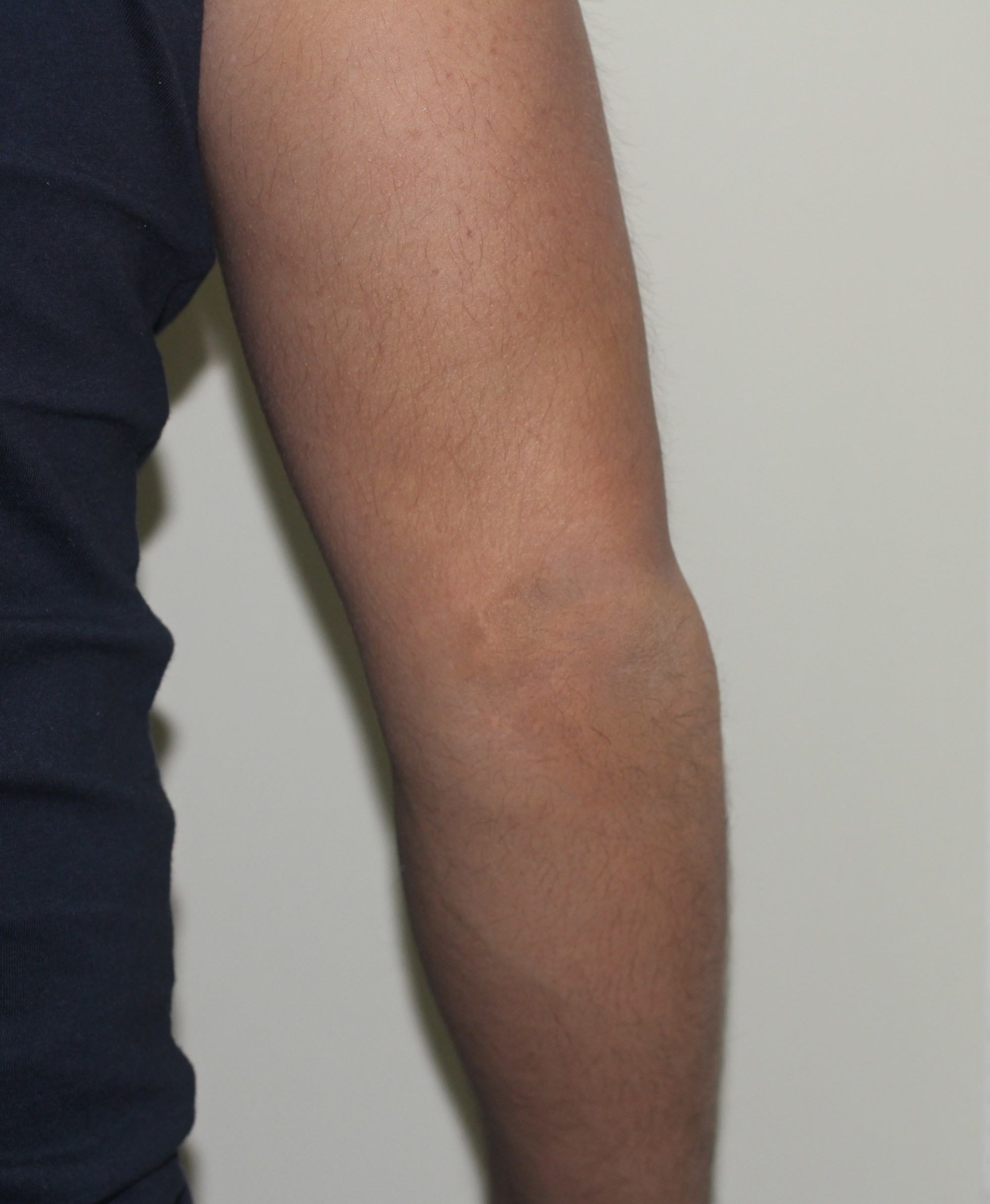 ab.Vitiligo After Camo