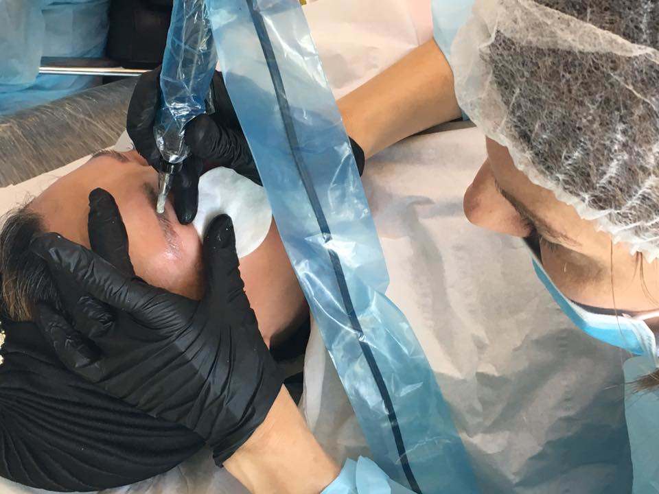 tattoo removal