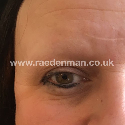 eyebrow medical tattoo before