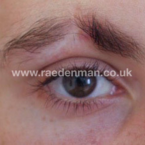 eyebrow medical tattoo before