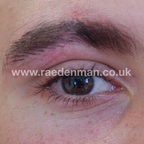 eyebrow medical tattoo after