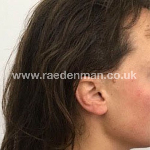 hair loss medical tattoo after