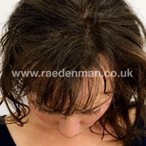 hair loss medical tattoo after