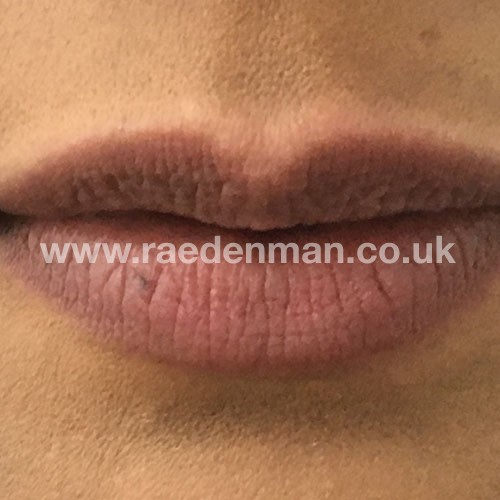 medical tattooing patchy lips before