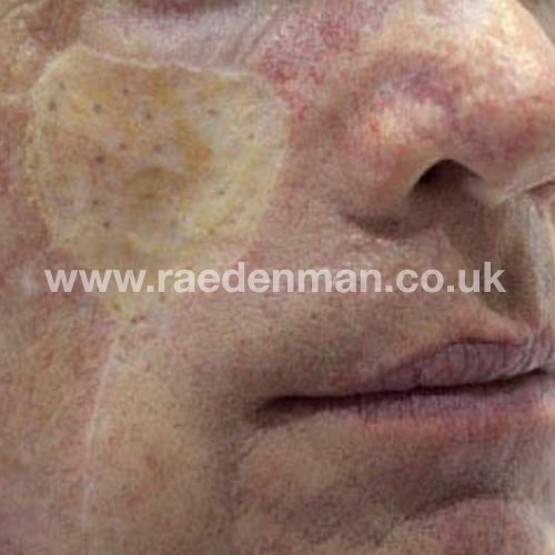 skin graft tattoo before