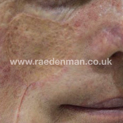 skin graft tattoo after