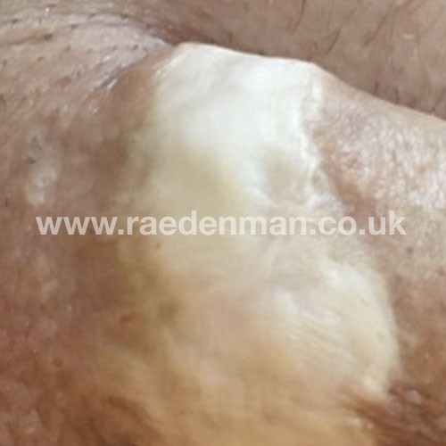 skin graft tattoo before