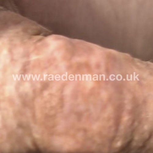 skin graft tattoo after